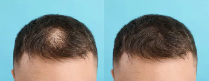 Kirkland 5% Minoxidil 男士生髮水 6支裝 Kirkland Minoxidil 香港現貨 Topical Solution Kirkland Topical Solution 男士頭髮護理液