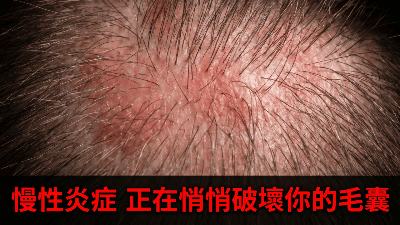 頭皮炎症特寫：慢性炎症正在悄悄破壞你的毛囊