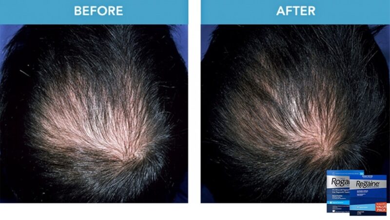 美國rogaine-5-minoxidil生髮劑（男士專用配方）（三支裝 3個月用量 ）：圖片 2