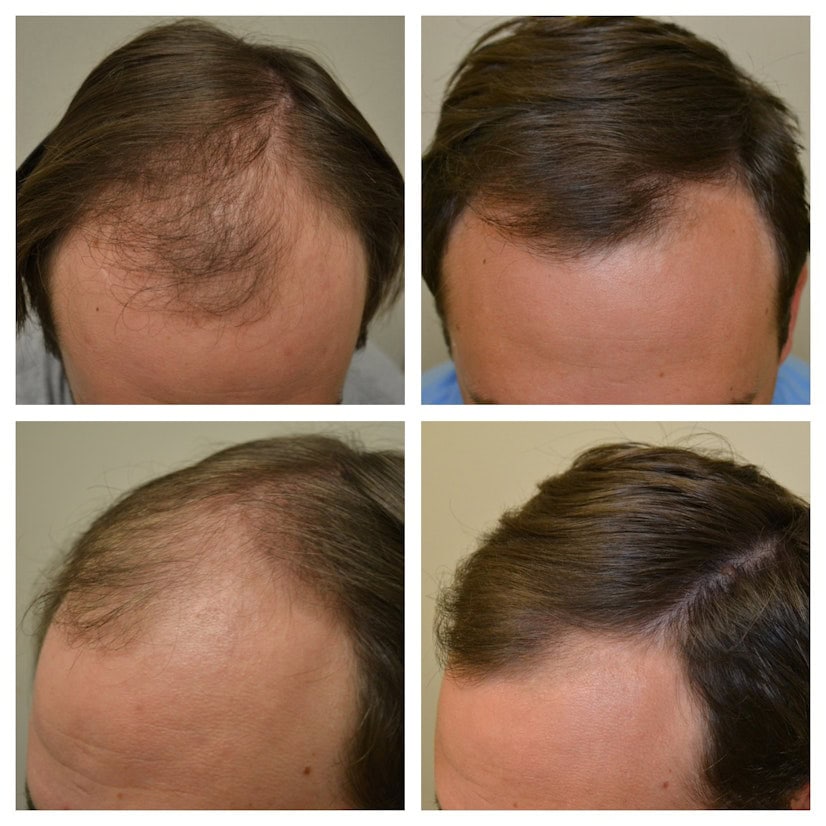 Minoxidil 使用前後對比 3