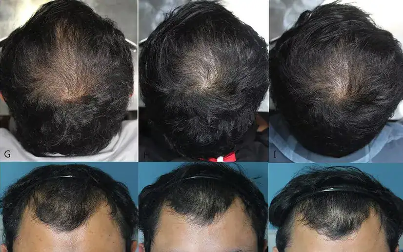 Minoxidil 使用前後效果對比