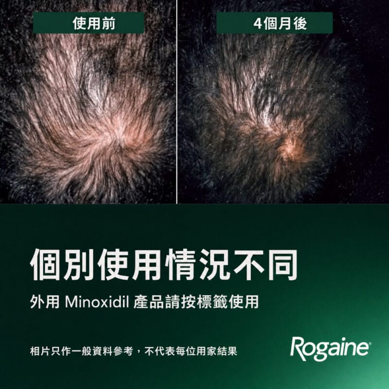 ROGAINE 5% Minoxidil 男士生髮泡沫